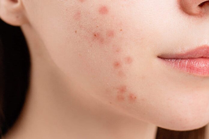 acne-2-scaled-1