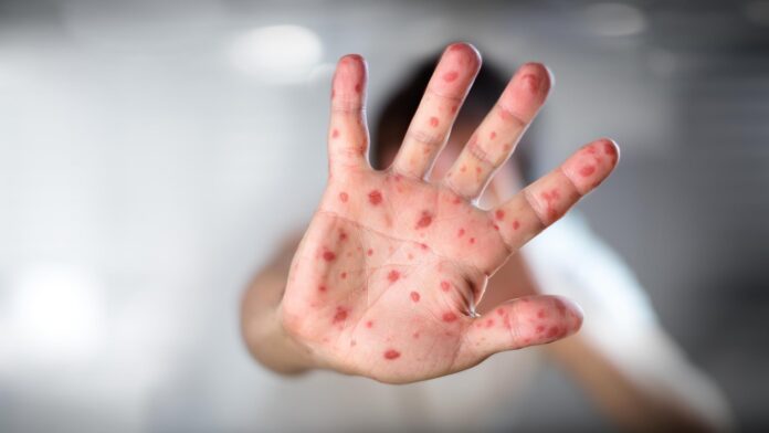 hidradenitis