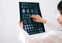 Día Mundial del Cerebro: cuáles son las señales de alerta que pueden ayudar a detectar un ACV